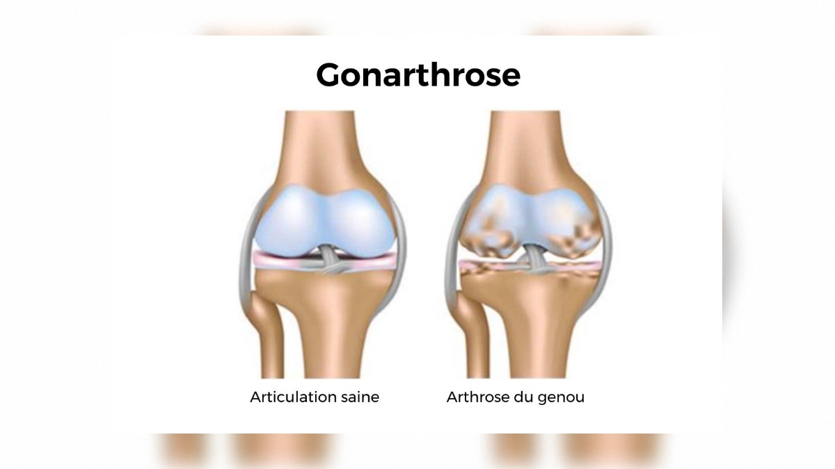Genou sain vs genou arthrosique